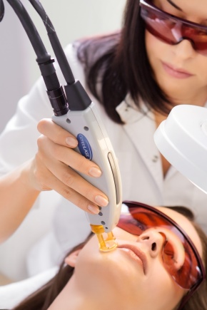 Epilation with alexandrite laser 