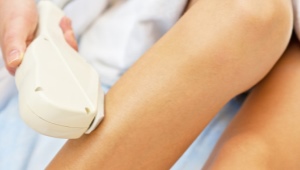 Photoepilation of the bikini zone