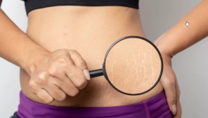 What helps with stretch marks?
